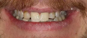 Before — Smile makeover · veneers at Pinecrest Dental, Taylorsville UT