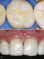 After — Cosmetic bonding at Pinecrest Dental, Taylorsville UT