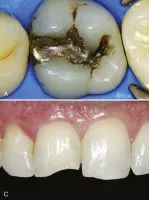 Before — Cosmetic bonding at Pinecrest Dental, Taylorsville UT