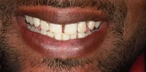 Before — Complete smile redesign at Pinecrest Dental, Taylorsville UT