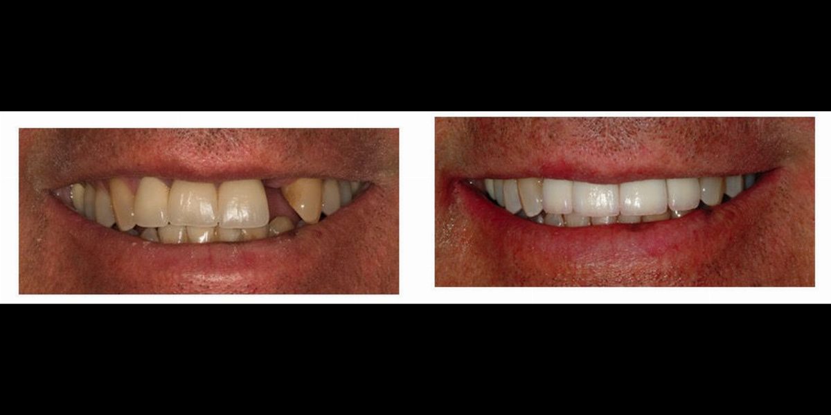 Before and after replacing a missing tooth with a dental implant at Pinecrest Dental, Taylorsville Utah