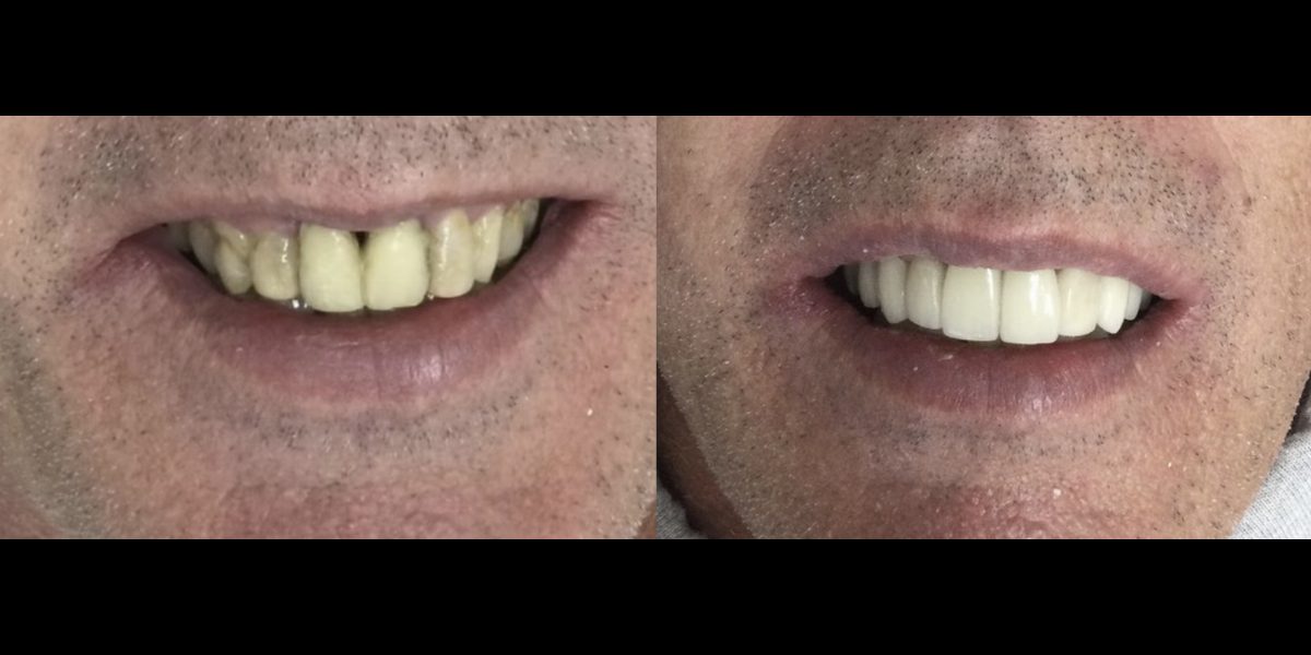 Before and after a full smile restoration with implants and crowns at Pinecrest Dental