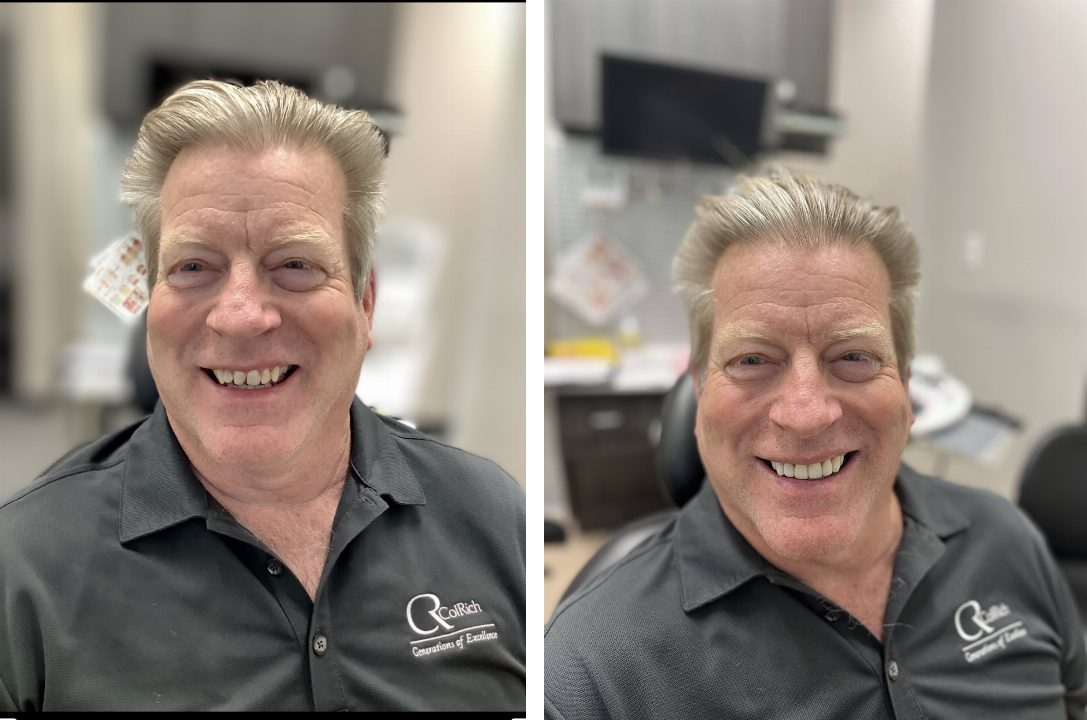 Before and after a full dental implant smile makeover at Pinecrest Dental, Taylorsville Utah