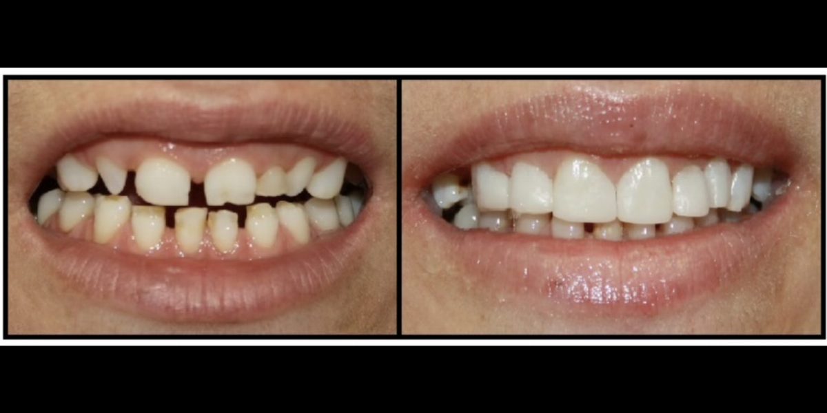 Before and after straightening and whitening a smile with veneers at Pinecrest Dental